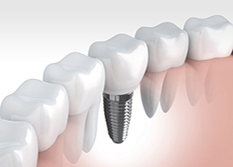 Tooth human implant (done in 3d graphics)